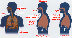 سازو کار ایجاد سکسکه