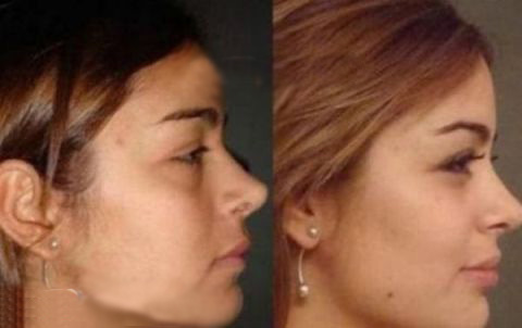 عکس هایی از قبل و بعد عمل زیبایی یک مانکن معروف ، www.irannaz.com