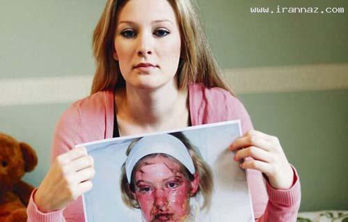 اتفاق بسیار دردناک برای دختر زیبای 19 ساله +عکس ، www.irannaz.com