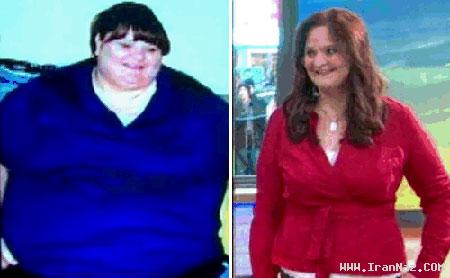 کاهش وزن باور نکردنی یک زن پس از جراحی +عکس ، www.irannaz.com